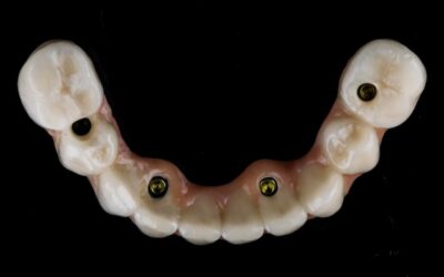 Jak wygląda koronka na zębie i czego można się spodziewać?