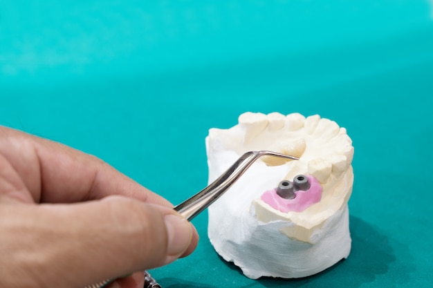 Czy usuwać kamień z zębów samodzielnie?