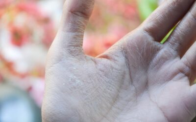 Gangrena objawy – na co warto zwrócić uwagę?