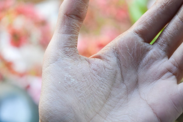 Gangrena objawy – na co warto zwrócić uwagę?