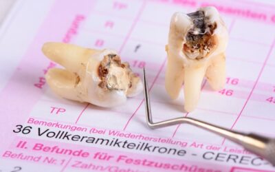 Od czego zależy ile kosztuje usunięcie zęba ósemki?