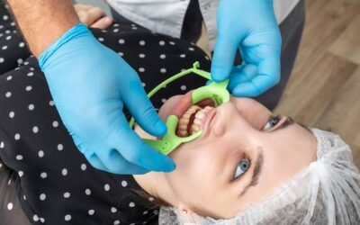 Czy usuwanie kamienia nazębnego wybiela zęby?