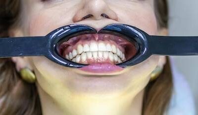 Jak rozpoznać recesję dziąseł i na co zwrócić uwagę?