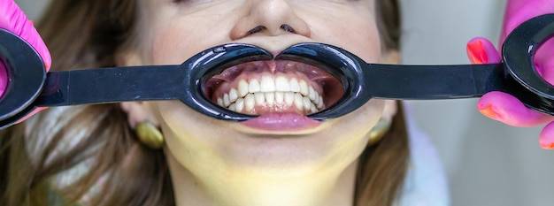 Jak rozpoznać recesję dziąseł i na co zwrócić uwagę?