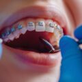 Ortodoncja Bielsko: Jak utrzymać efekt prostych zębów po zdjęciu aparatu?